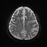 Cerebral embolic infarcts (embolic shower) (Radiopaedia 72391-82921 Axial DWI 21).jpg