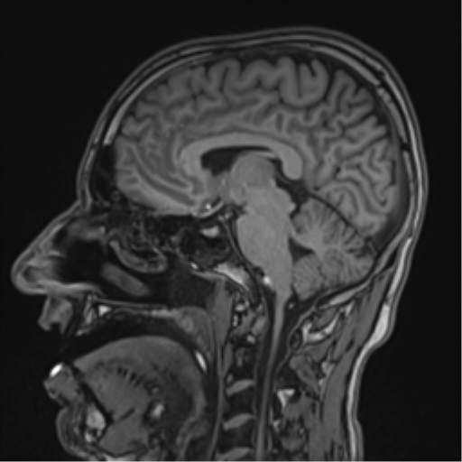 Cerebral fat embolism (Radiopaedia 57697-64639 Sagittal T1 28).png