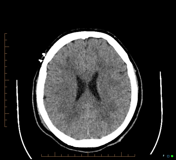 Cerebral fat embolism (Radiopaedia 85521-101220 Axial non-contrast 40).jpg