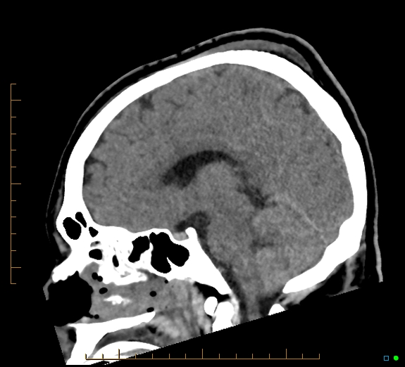 Cerebral fat embolism (Radiopaedia 85521-101224 C 28).jpg