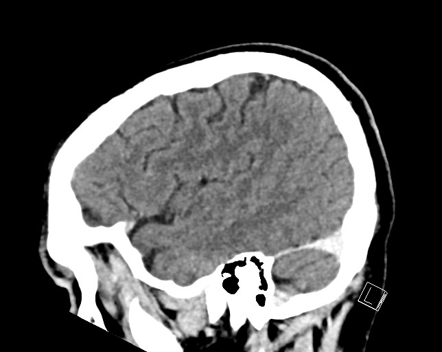 Cerebral metastases - testicular choriocarcinoma (Radiopaedia 84486-99855 F 45).jpg