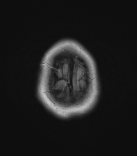 File:Cerebral metastases mimicking abscesses (Radiopaedia 45841-50131 Axial FLAIR 27).png
