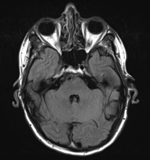 File:Cerebral metastasis - melanoma (Radiopaedia 54718-60954 Axial FLAIR 9).png