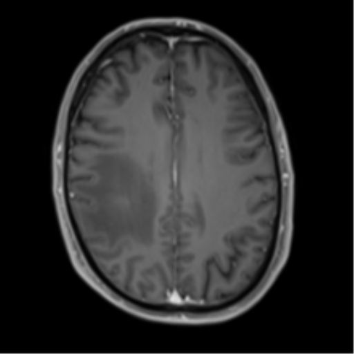 Cerebral metastasis - melanoma (Radiopaedia 54718-60954 Axial T1 C+ fat sat 36).png