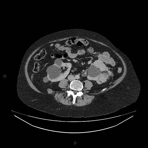 File:Cerebral metastasis from renal cell carcinoma (Radiopaedia 82306-96378 A 105).jpg