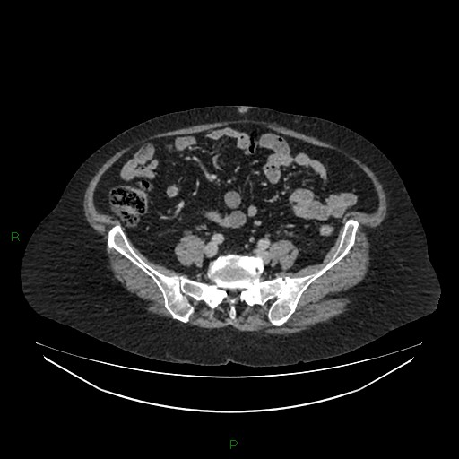 Cerebral metastasis from renal cell carcinoma (Radiopaedia 82306-96378 A 128).jpg