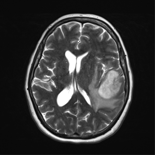 File:Cerebral metastasis mimicking glioblastoma (Radiopaedia 69155-78937 Axial T2 24).png