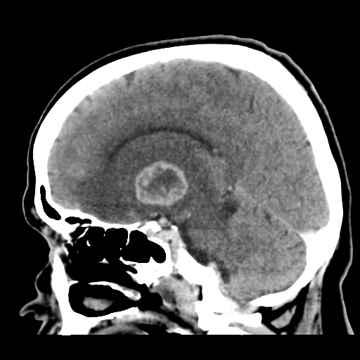 Cerebral metastasis to basal ganglia (Radiopaedia 81568-95412 Sagittal C+ delayed 26).png