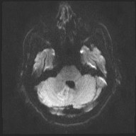 File:Cerebral toxoplasmosis (Radiopaedia 43956-47461 Axial DWI 6).jpg