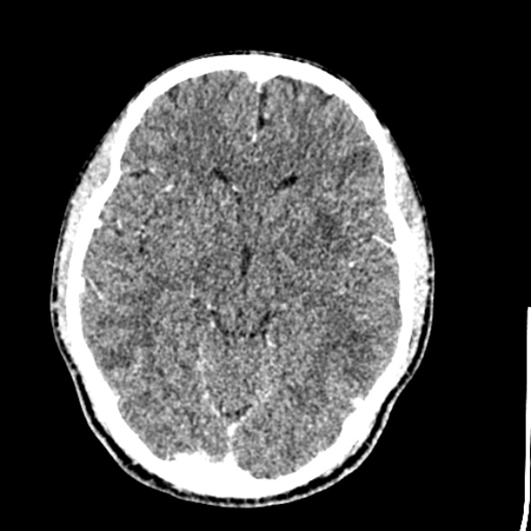 Cerebral toxoplasmosis (Radiopaedia 53993-60131 Axial C+ delayed 33).jpg