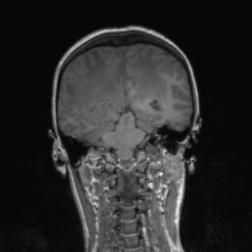 Cerebral tuberculosis with dural sinus invasion (Radiopaedia 60353-68090 Coronal T1 121).jpg