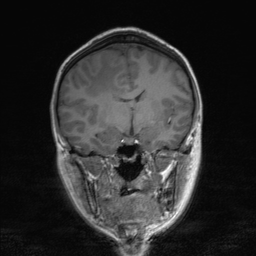 Cerebral tuberculosis with dural sinus invasion (Radiopaedia 60353-68090 Coronal T1 87).jpg
