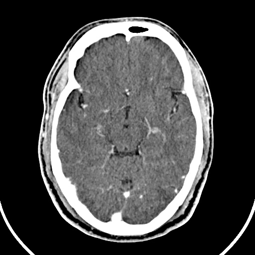 Cerebral venous angioma (Radiopaedia 69959-79977 B 32).jpg