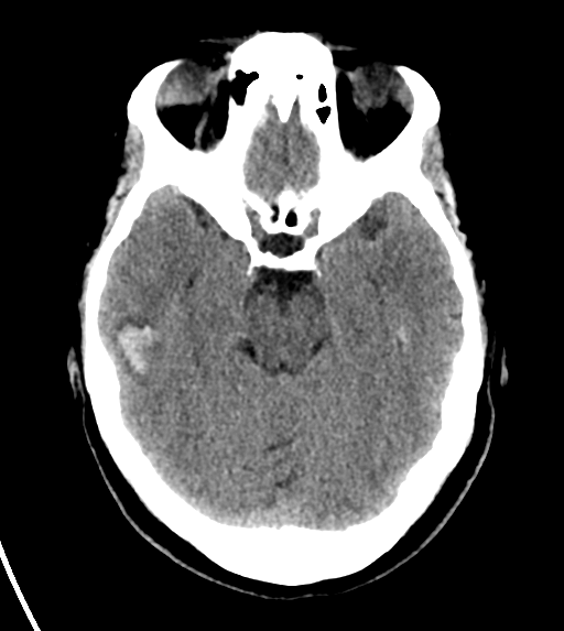 File:Cerebral venous infarct related to dural venous sinus thromboses (Radiopaedia 35292-36804 Axial non-contrast 11).png