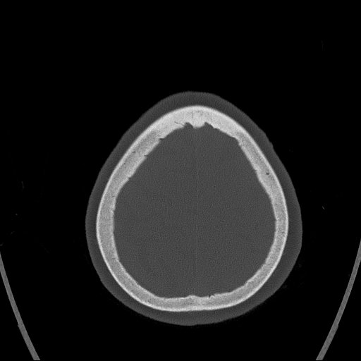 Cerebral venous infarction with hemorrhage (Radiopaedia 65343-74381 Axial bone window 166).jpg