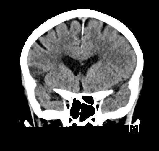 File:Cerebral venous infarction with hemorrhage (Radiopaedia 65343-74381 Coronal non-contrast 17).jpg