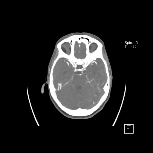 Cerebral venous infarction with hemorrhage (Radiopaedia 65343-74396 A 38).jpg