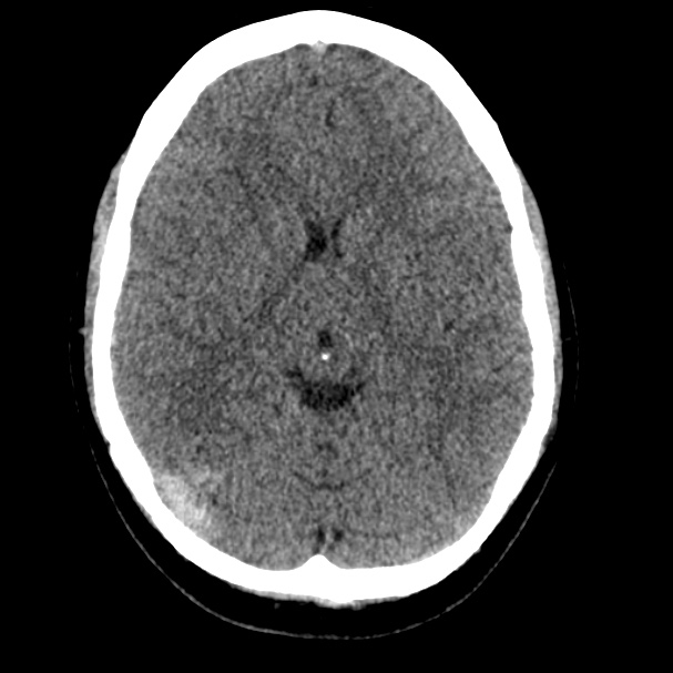 Cerebral venous sinus thrombosis (Radiopaedia 59224-66551 Axial non-contrast 10).jpg