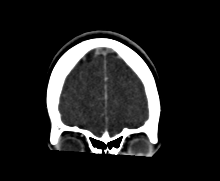 Cerebral venous sinus thrombosis (Radiopaedia 59224-66646 Coronal C+ delayed 7).jpg