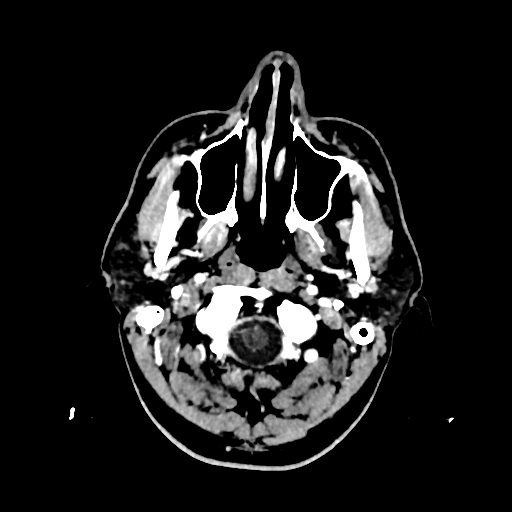 File:Cerebral venous thrombosis (CVT) (Radiopaedia 77524-89685 Axial with contrast 2).jpg
