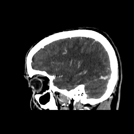 File:Cerebral venous thrombosis (CVT) (Radiopaedia 77524-89685 Sagittal CTV 9).jpg