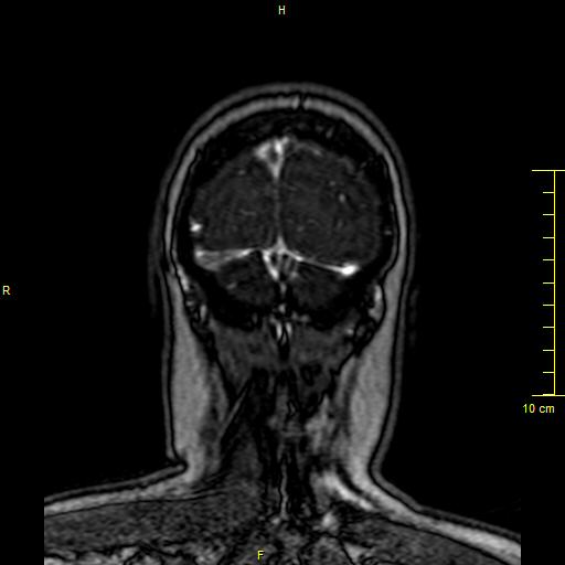 Cerebral venous thrombosis (Radiopaedia 23288-23351 MRV 164).JPG