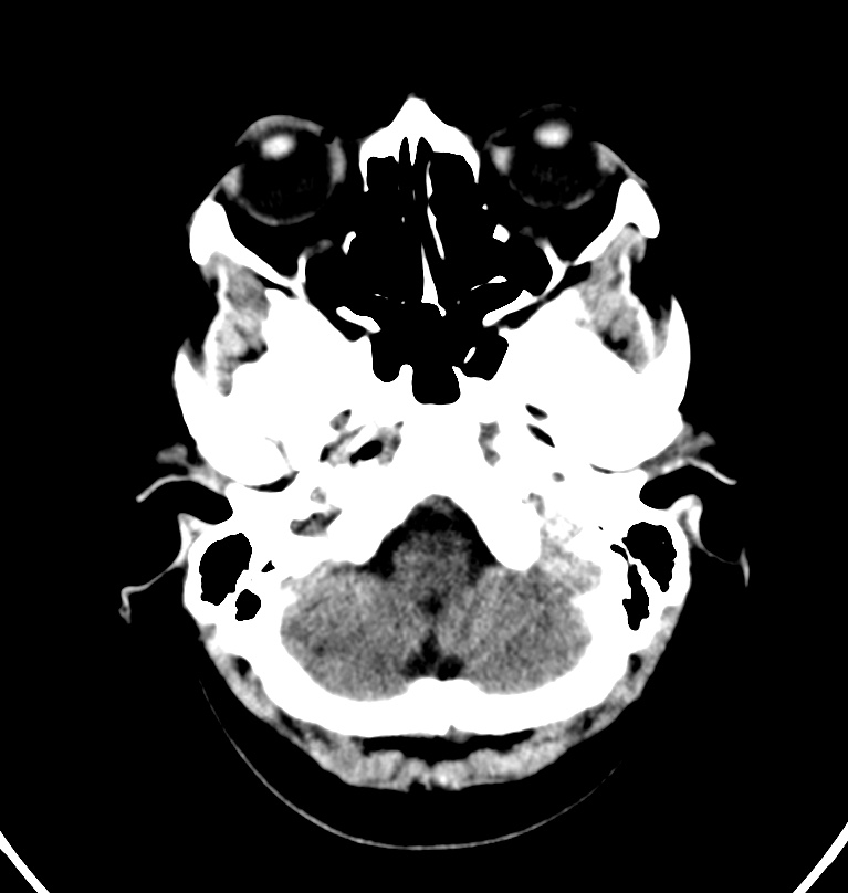 Cerebral venous thrombosis - CT only (Radiopaedia 41031-43778 Axial non-contrast 75).jpg