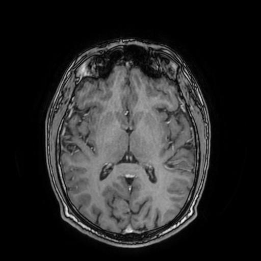 File:Cerebral venous thrombosis with secondary intracranial hypertension (Radiopaedia 89842-106957 Axial T1 C+ 98).jpg