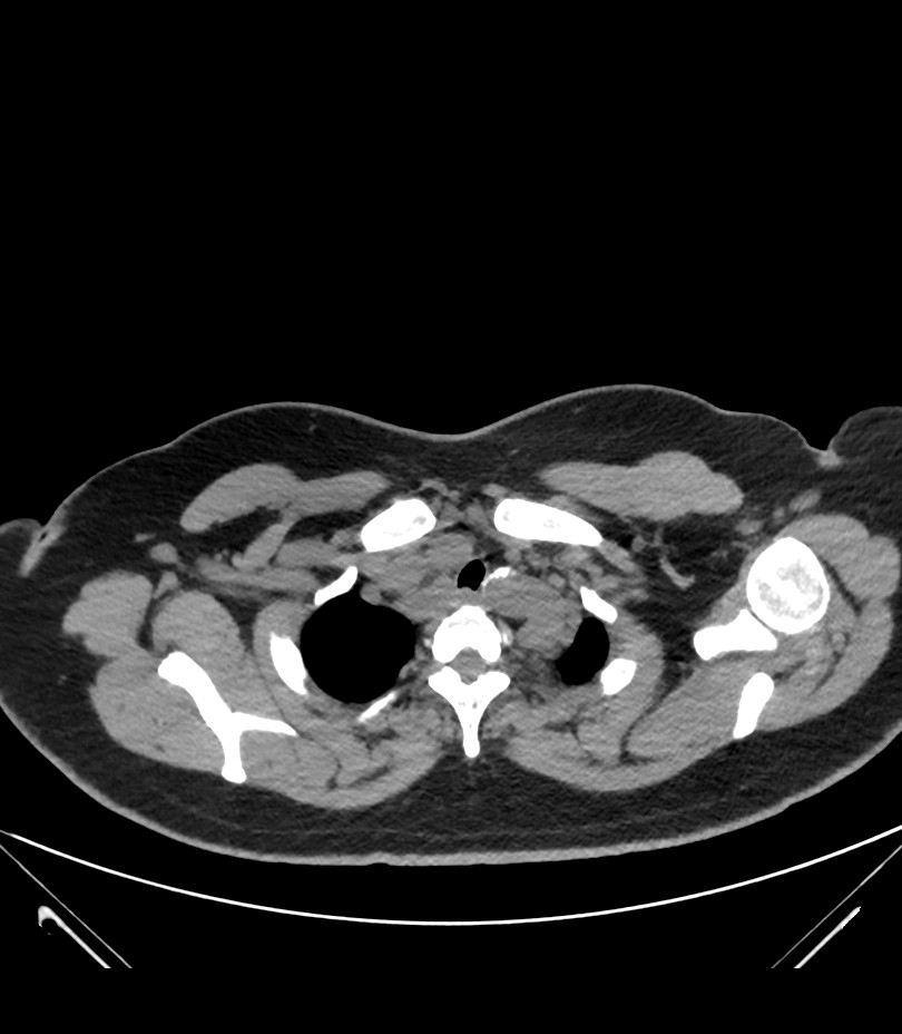 Cervical aortic arch with coarctation and aneurysms (Radiopaedia 44035-47552 Axial non-contrast 11).jpg