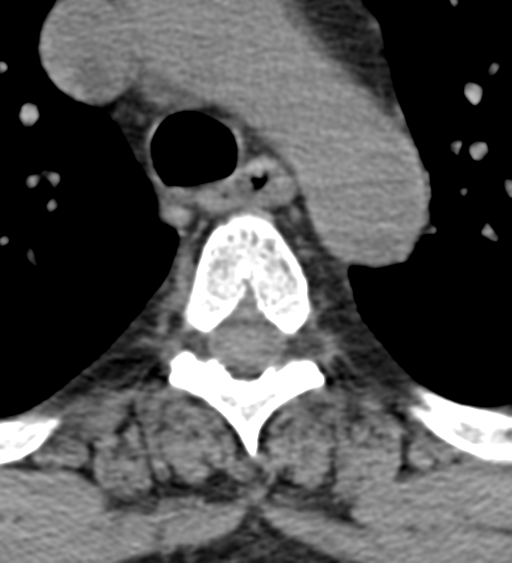File:Cervical canal stenosis due to ossification of the posterior longitudinal ligament (Radiopaedia 47260-51823 Axial non-contrast 77).png