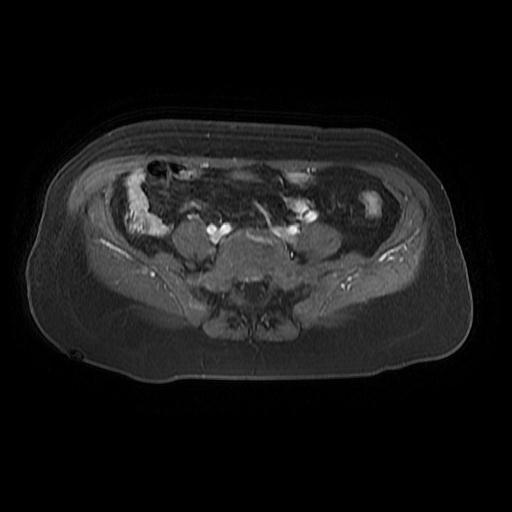 File:Cervical carcinoma (Radiopaedia 67644-77047 Axial T1 C+ fat sat 4).jpg