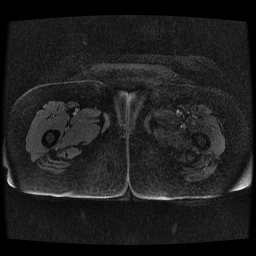 File:Cervical carcinoma (Radiopaedia 70924-81132 Axial T1 C+ fat sat 3).jpg