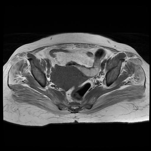 File:Cervical carcinoma (Radiopaedia 88010-104555 Axial T1 10).jpg