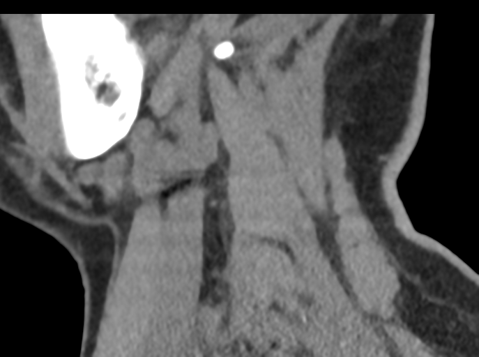 File:Cervical disc replacement (Radiopaedia 44025-47541 B 21).png
