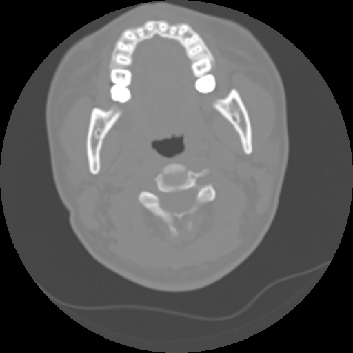 Cervical rib (Radiopaedia 71110-81363 Axial non-contrast 24).jpg