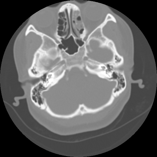 Cervical rib (Radiopaedia 71110-81363 Axial non-contrast 8).jpg