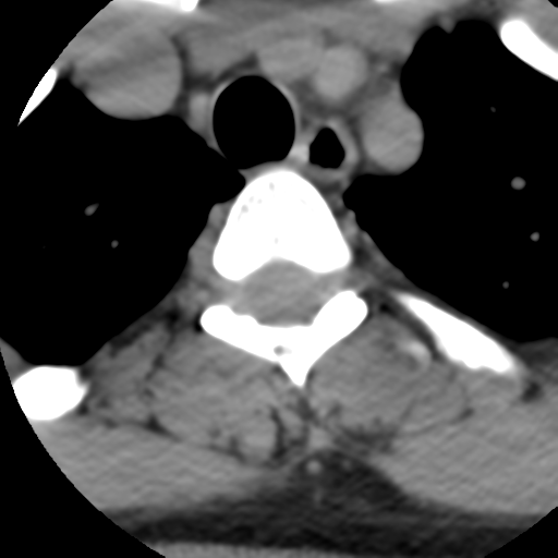 Cervical schwannoma (Radiopaedia 57979-64974 Axial non-contrast 69).png