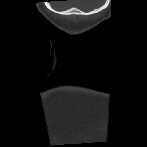 Cervical schwannoma (Radiopaedia 57979-64974 Coronal bone window 66).png