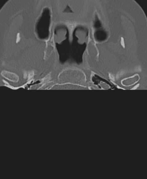 Cervical spine ACDF loosening (Radiopaedia 48998-54071 Axial bone window 3).png