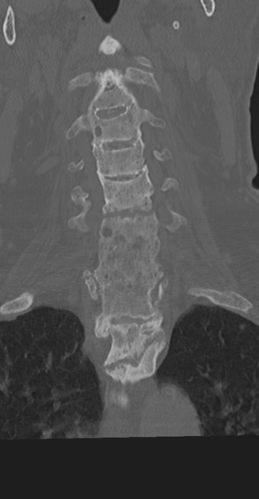 Cervical spine fracture in the setting of ankylosis (Radiopaedia 37038-38715 Coronal bone window 28).png