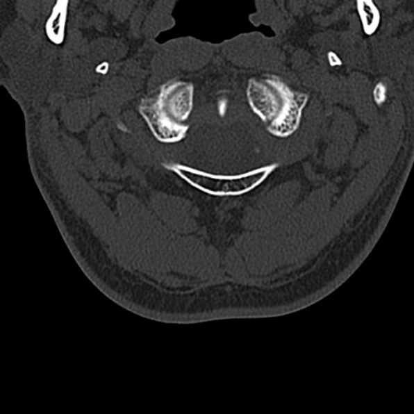 Cervical spondylodiscitis (Radiopaedia 28057-29489 Axial bone window 16).jpg