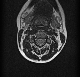 File:Cervical spondylodiscitis and calvarial hemangioma (Radiopaedia 64317-73104 Axial T2 2).jpg
