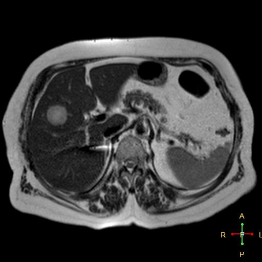 File:Cervical stump squamous cell carcinoma (Radiopaedia 48049-52858 I 8).jpg