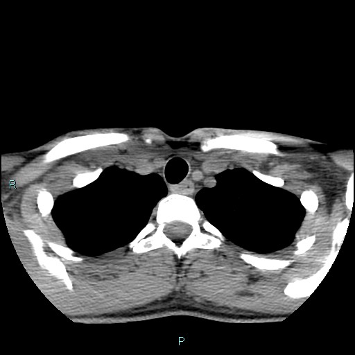 File:Cervical thymic cyst (Radiopaedia 88632-105335 Axial non-contrast 25).jpg