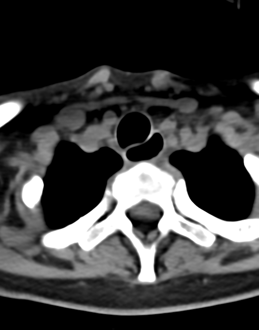 Cervical tuberculous spondylitis (Radiopaedia 39149-41365 Axial non-contrast 48).png