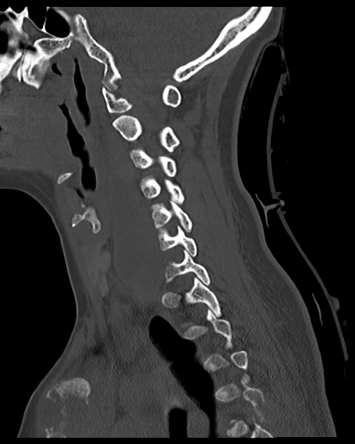 Cervical tuberculous spondylitis (Radiopaedia 39149-41365 Sagittal bone window 43).png