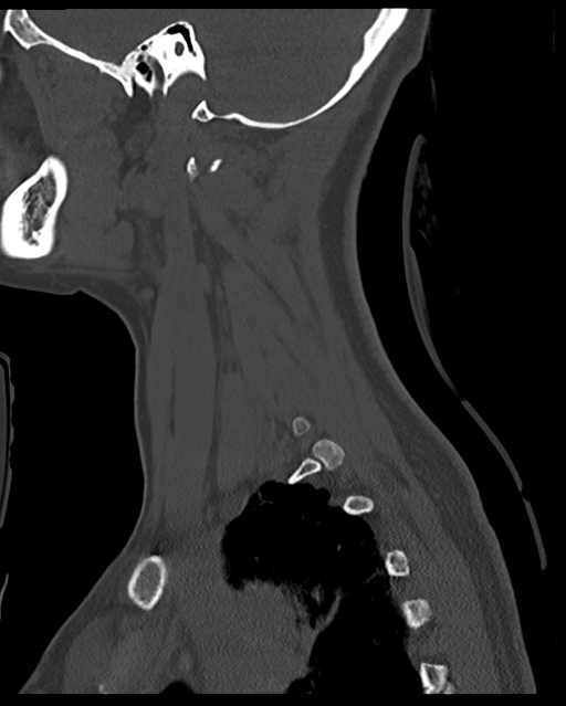 Cervical tuberculous spondylitis (Radiopaedia 39149-41365 Sagittal bone window 55).png