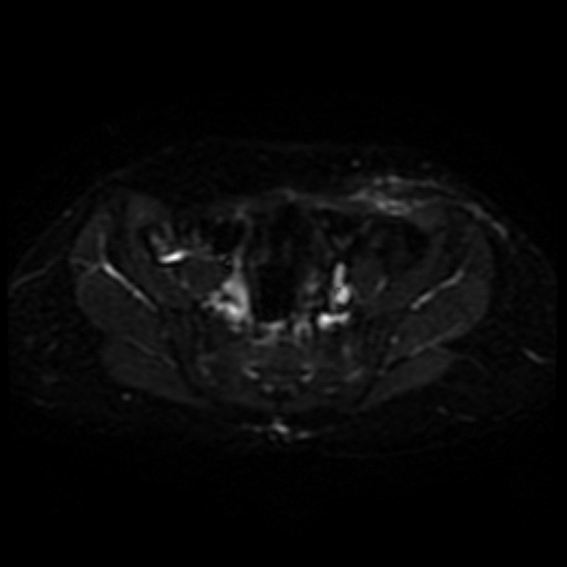 File:Cesarian section scar endometriosis (Radiopaedia 66520-75799 Axial DWI 6).jpg