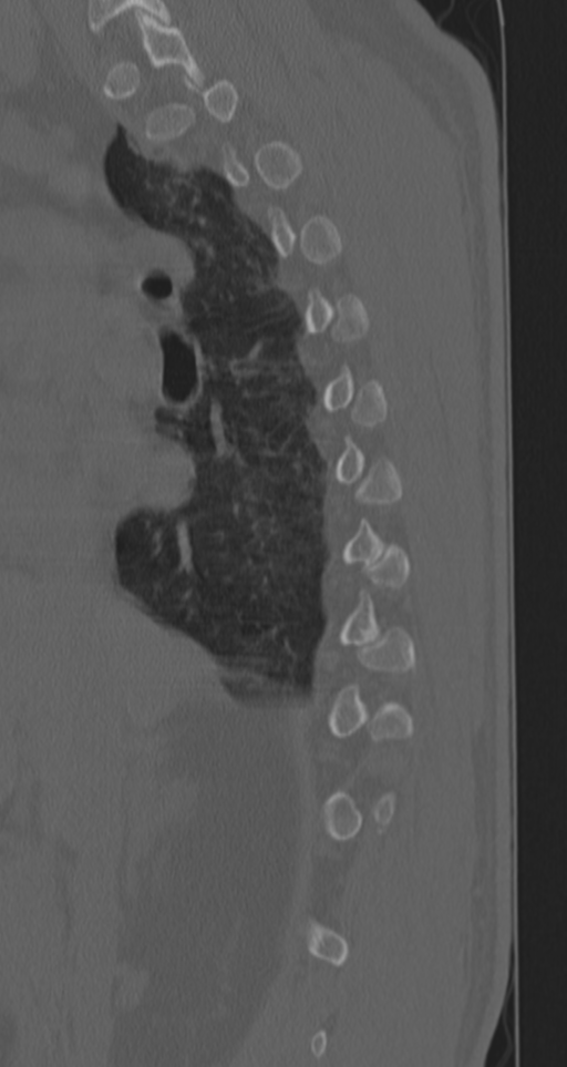 Chance fracture (Radiopaedia 33854-35020 Sagittal bone window 61).png