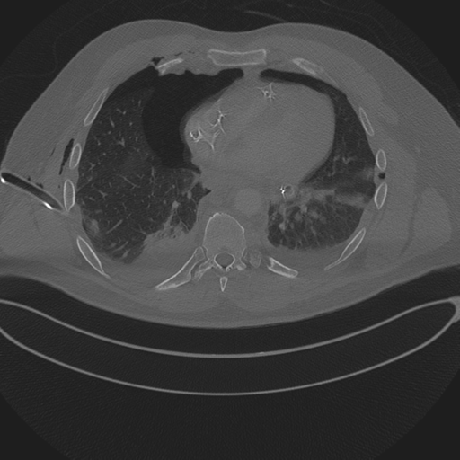 Chest multitrauma - aortic injury (Radiopaedia 34708-36147 Axial bone window 191).png